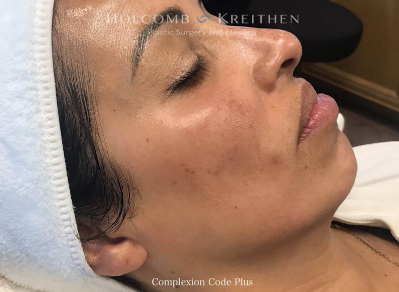 Complexion Code Plus Before & After Gallery - Patient 141952 - Image 2