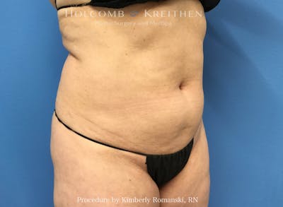 CoolSculpting Before & After Gallery - Patient 196480 - Image 1
