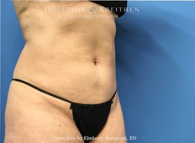 CoolSculpting Before & After Gallery - Patient 196480 - Image 2