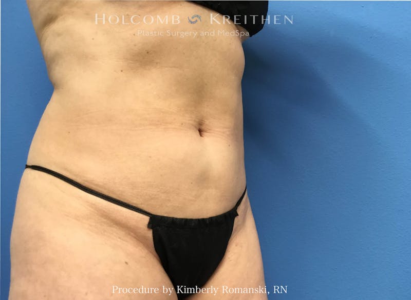 CoolSculpting Before & After Gallery - Patient 196480 - Image 2
