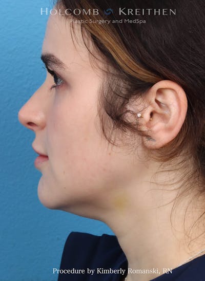CoolSculpting Before & After Gallery - Patient 265866 - Image 1