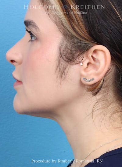 CoolSculpting Before & After Gallery - Patient 265866 - Image 2