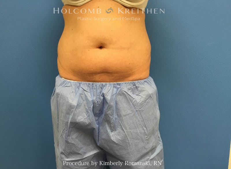 CoolSculpting Before & After Gallery - Patient 267201 - Image 1