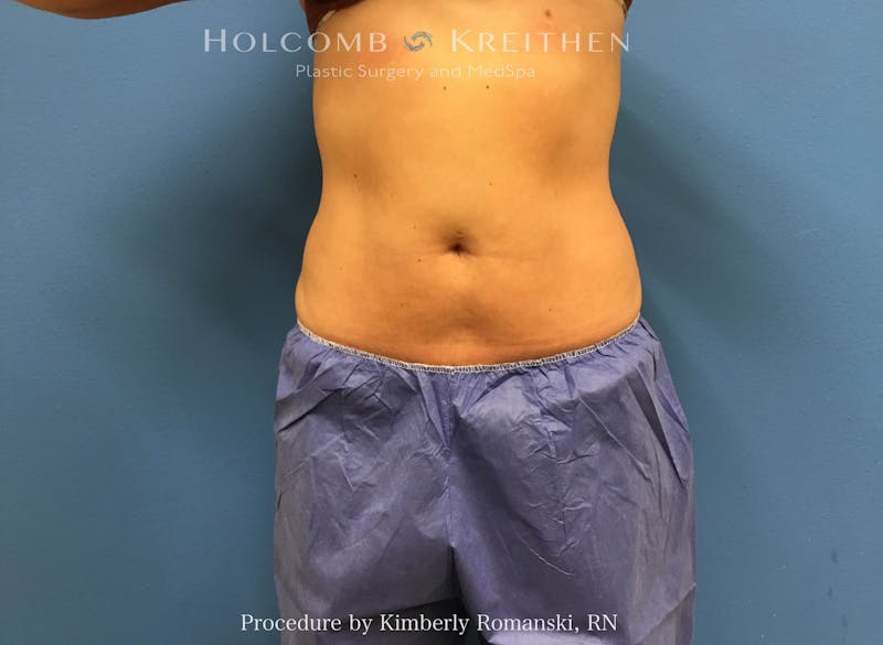CoolSculpting Before & After Gallery - Patient 267201 - Image 2