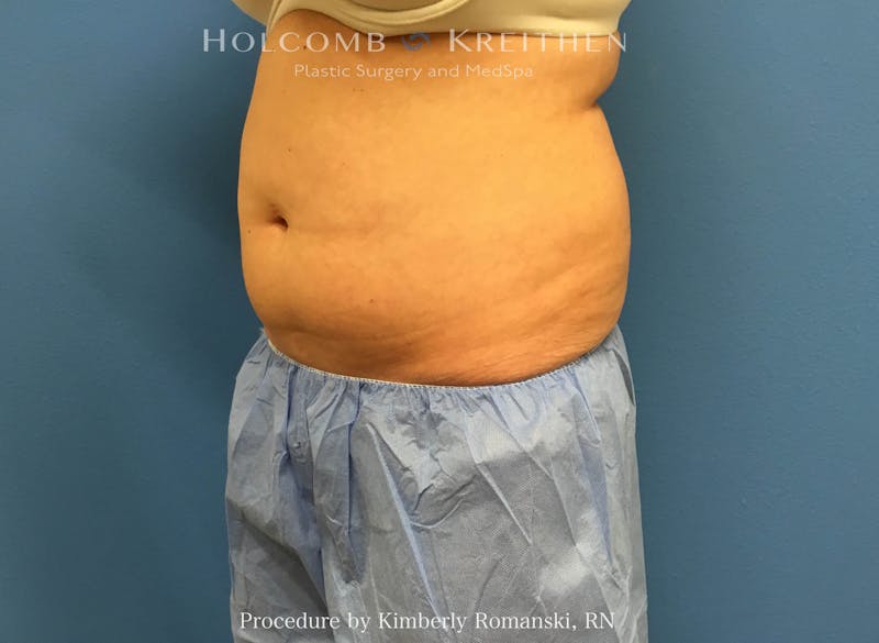 CoolSculpting Before & After Gallery - Patient 267201 - Image 3