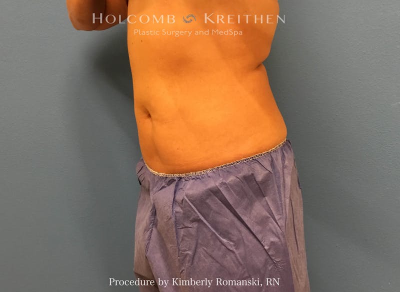 CoolSculpting Before & After Gallery - Patient 267201 - Image 4