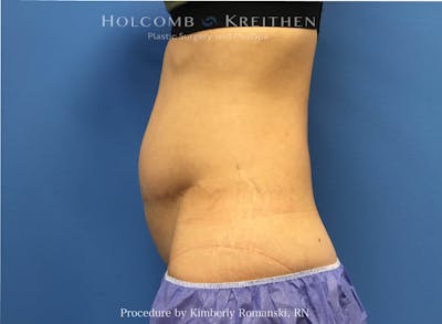 CoolSculpting Before & After Gallery - Patient 291985 - Image 1