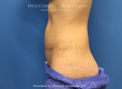 CoolSculpting Before & After Gallery - Patient 291985 - Image 2