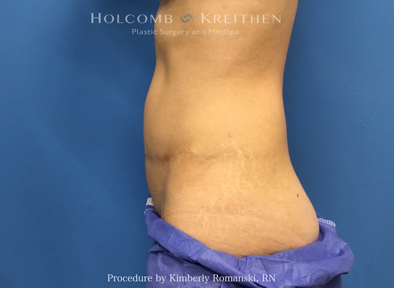 CoolSculpting Before & After Gallery - Patient 291985 - Image 2