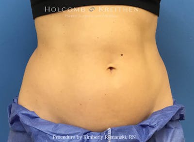 CoolSculpting Before & After Gallery - Patient 188188 - Image 1