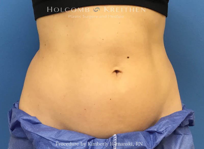 CoolSculpting Before & After Gallery - Patient 188188 - Image 1