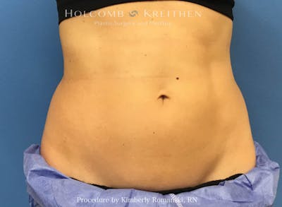 CoolSculpting Before & After Gallery - Patient 188188 - Image 2