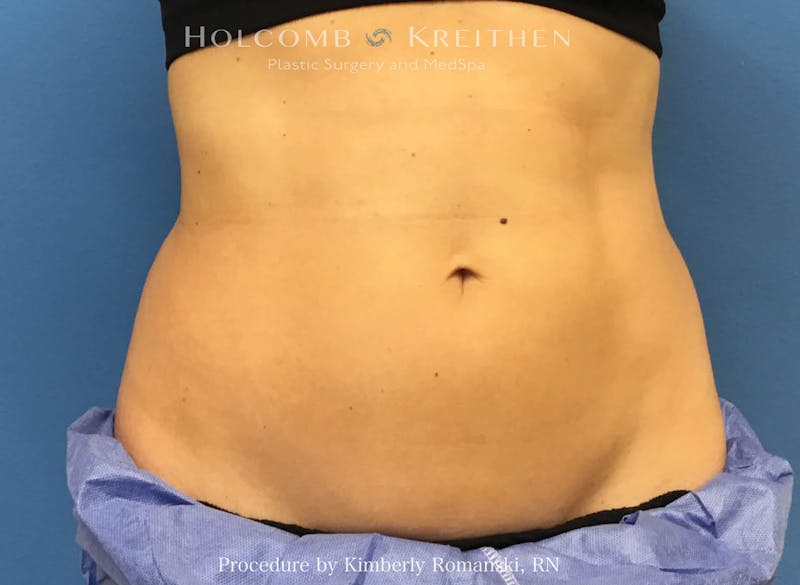 CoolSculpting Before & After Gallery - Patient 188188 - Image 2