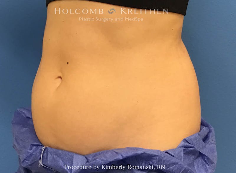 CoolSculpting Before & After Gallery - Patient 188188 - Image 3