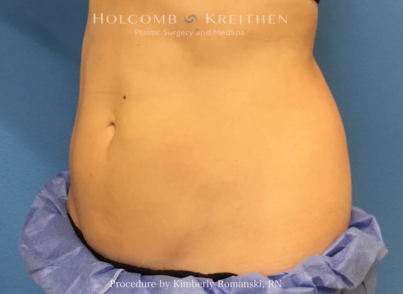 CoolSculpting Before & After Gallery - Patient 188188 - Image 4