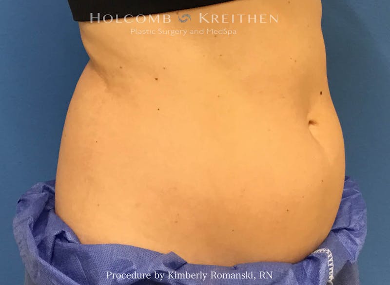 CoolSculpting Before & After Gallery - Patient 188188 - Image 5
