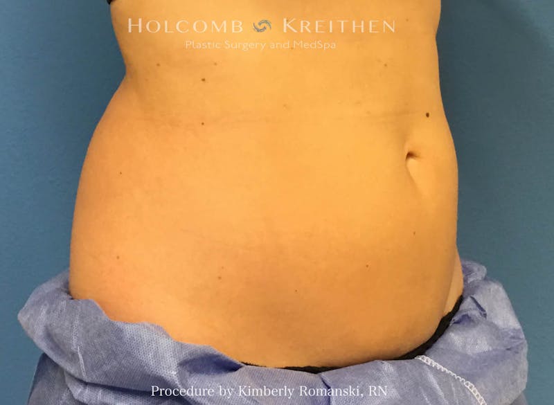CoolSculpting Before & After Gallery - Patient 188188 - Image 6