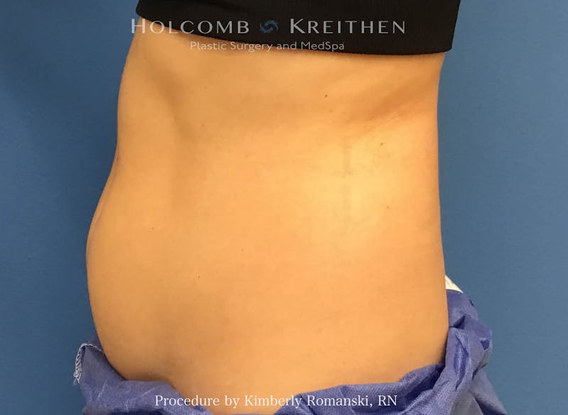 CoolSculpting Before & After Gallery - Patient 188188 - Image 7