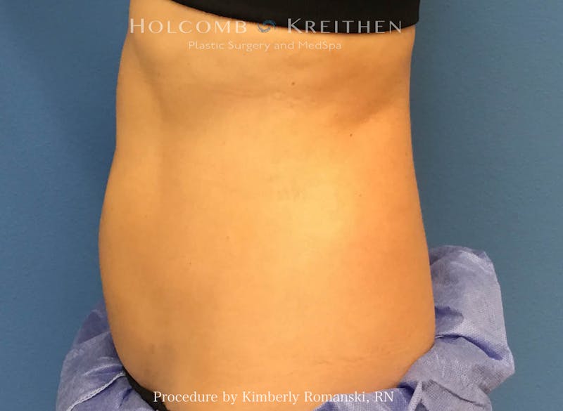 CoolSculpting Before & After Gallery - Patient 188188 - Image 8