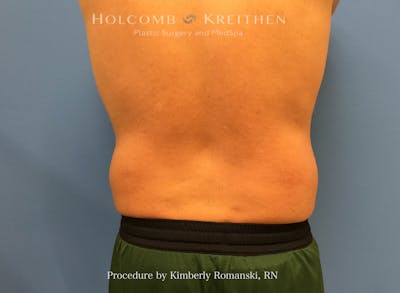CoolSculpting Before & After Gallery - Patient 995725 - Image 1
