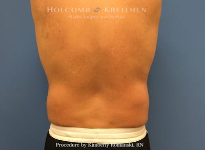 CoolSculpting Before & After Gallery - Patient 995725 - Image 2