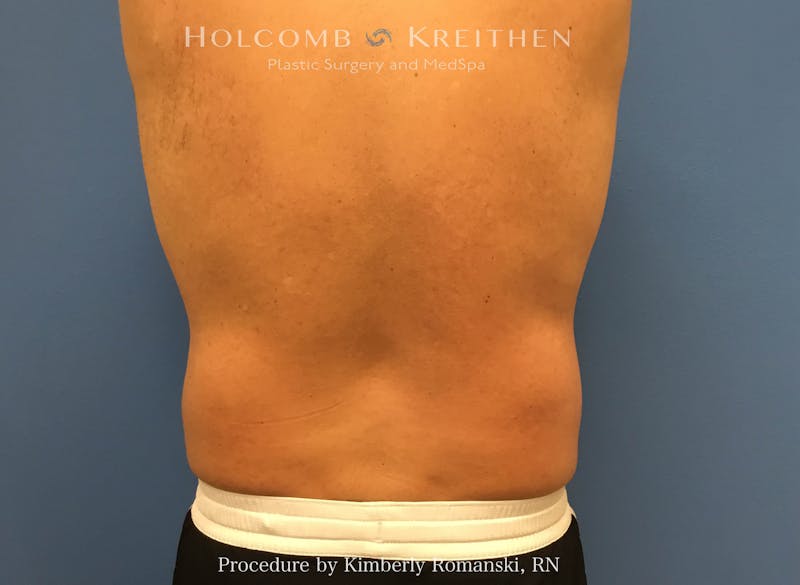 CoolSculpting Before & After Gallery - Patient 995725 - Image 2