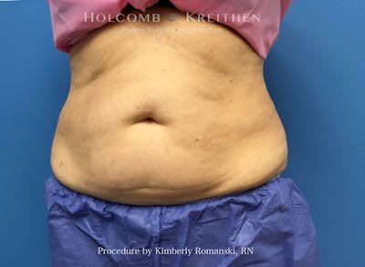 CoolSculpting Before & After Gallery - Patient 840294 - Image 1