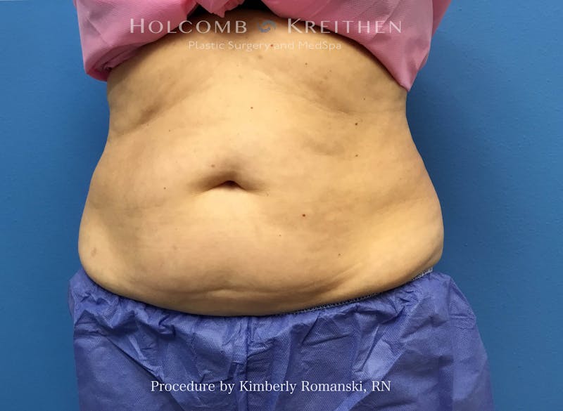 CoolSculpting Before & After Gallery - Patient 840294 - Image 1