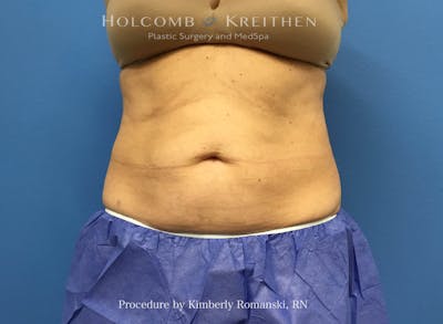 CoolSculpting Before & After Gallery - Patient 840294 - Image 2