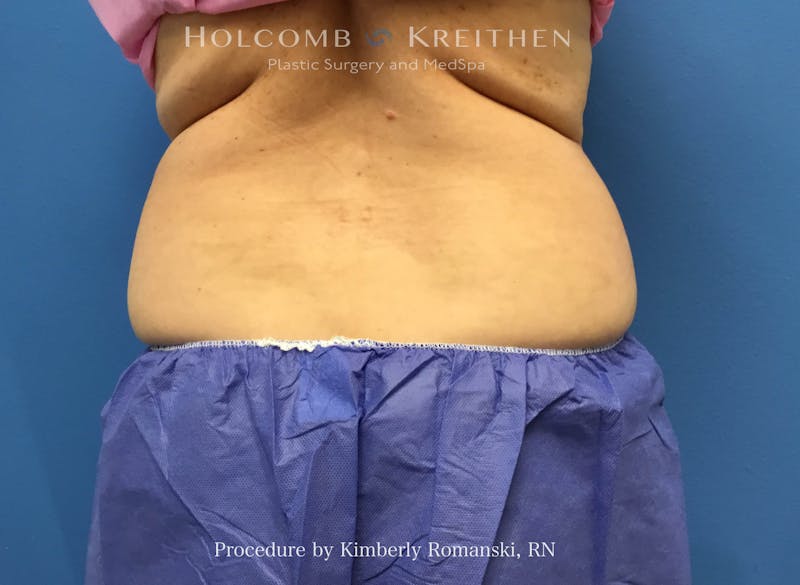 CoolSculpting Before & After Gallery - Patient 840294 - Image 3