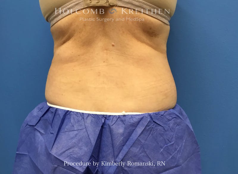 CoolSculpting Before & After Gallery - Patient 840294 - Image 4