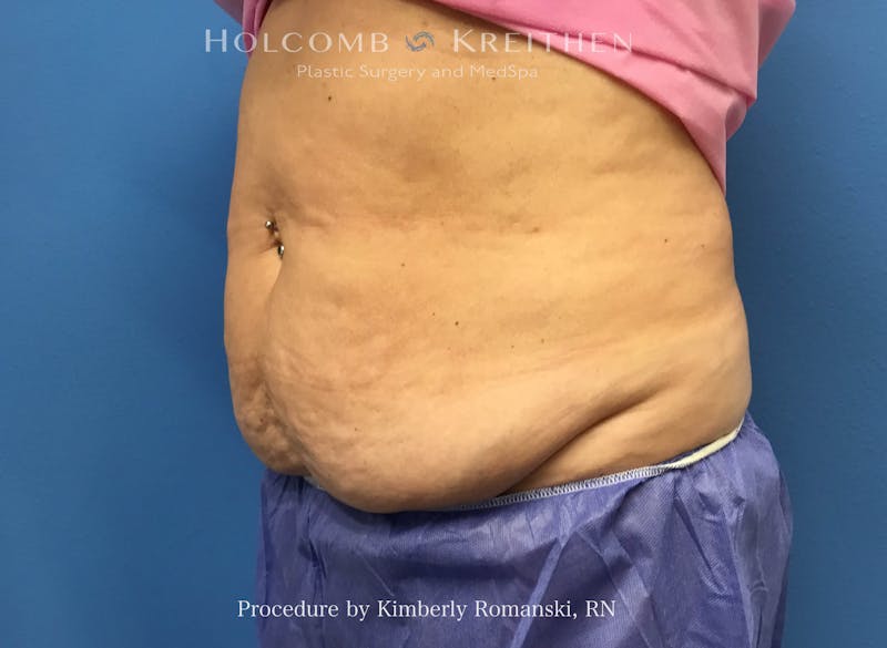CoolSculpting Before & After Gallery - Patient 294767 - Image 1