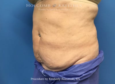 CoolSculpting Before & After Gallery - Patient 294767 - Image 2