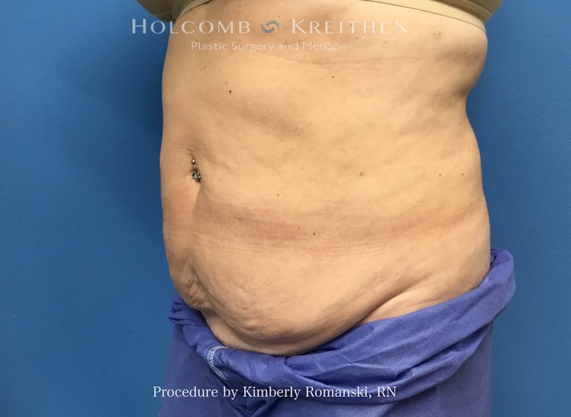CoolSculpting Before & After Gallery - Patient 294767 - Image 2