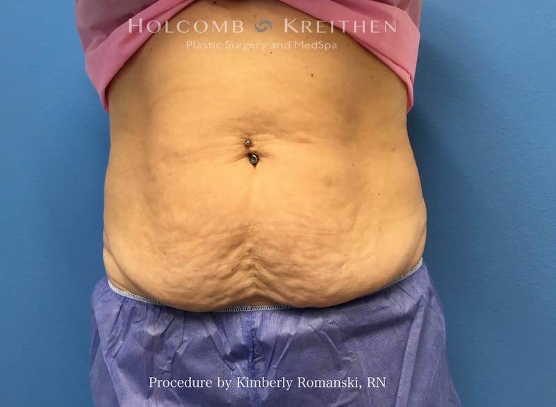 CoolSculpting Before & After Gallery - Patient 294767 - Image 3