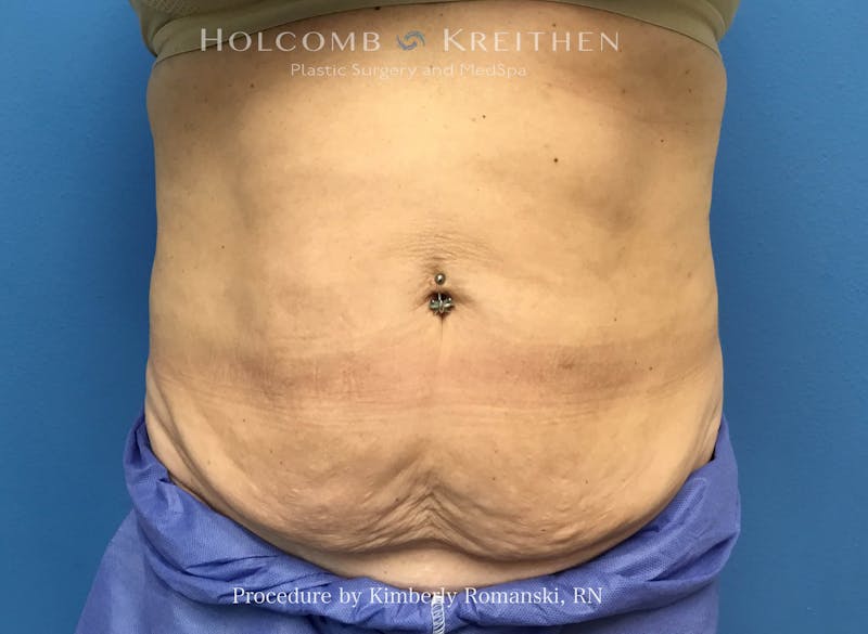 CoolSculpting Before & After Gallery - Patient 294767 - Image 4