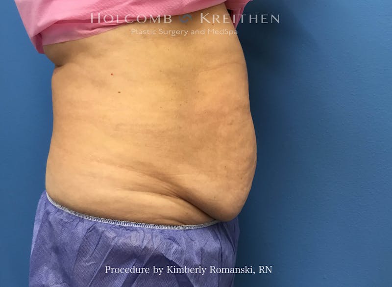 CoolSculpting Before & After Gallery - Patient 294767 - Image 5