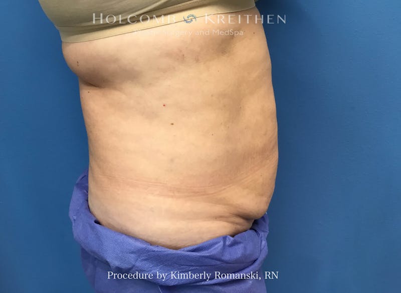 CoolSculpting Before & After Gallery - Patient 294767 - Image 6