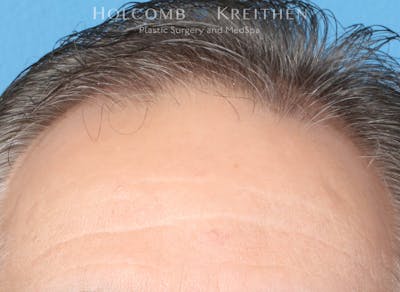 Neograft 2.0 Before & After Gallery - Patient 225725 - Image 1