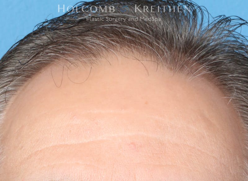 Neograft 2.0 Before & After Gallery - Patient 225725 - Image 1