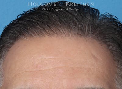 Neograft 2.0 Before & After Gallery - Patient 225725 - Image 2
