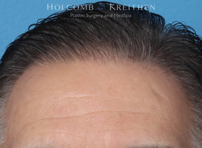 Neograft 2.0 Before & After Gallery - Patient 225725 - Image 2