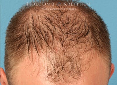 Neograft 2.0 Before & After Gallery - Patient 278108 - Image 1