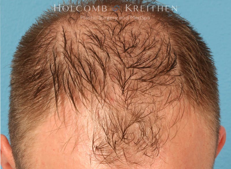 Neograft 2.0 Before & After Gallery - Patient 278108 - Image 1
