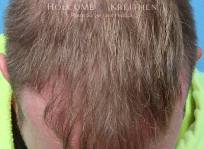 Neograft 2.0 Before & After Gallery - Patient 278108 - Image 2