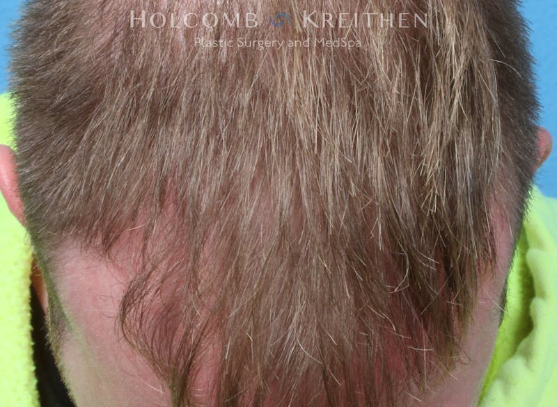 Neograft 2.0 Before & After Gallery - Patient 278108 - Image 2