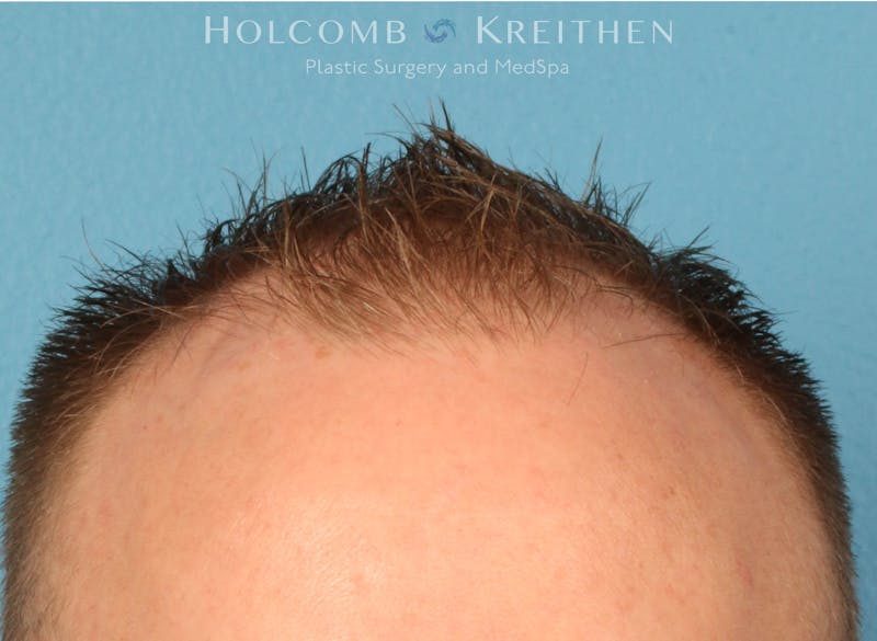Neograft 2.0 Before & After Gallery - Patient 278108 - Image 3