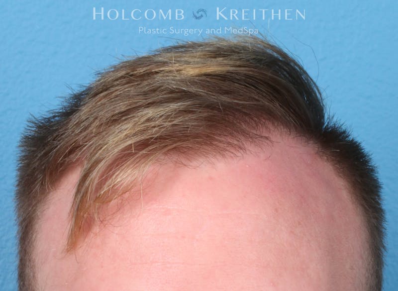 Neograft 2.0 Before & After Gallery - Patient 278108 - Image 4