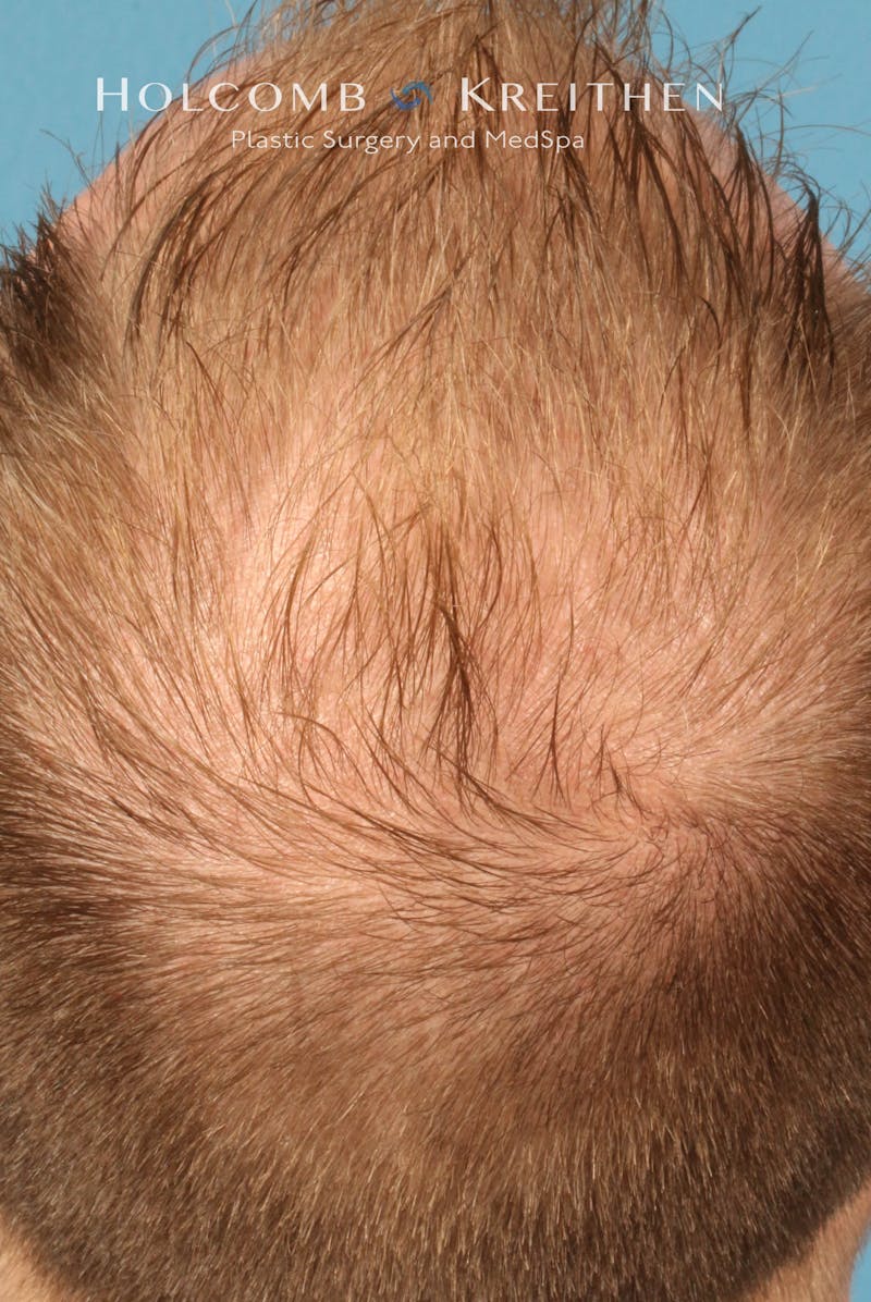 Neograft 2.0 Before & After Gallery - Patient 278108 - Image 5