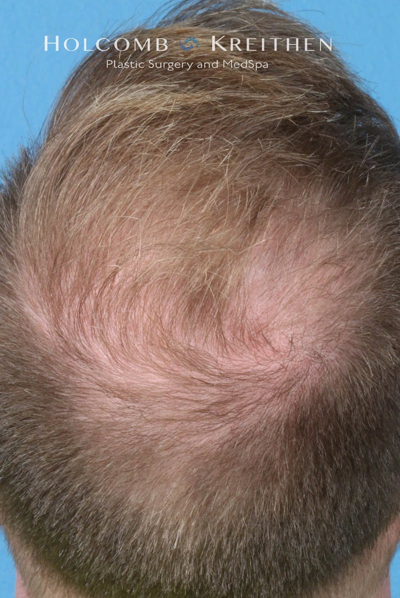 Neograft 2.0 Before & After Gallery - Patient 278108 - Image 6
